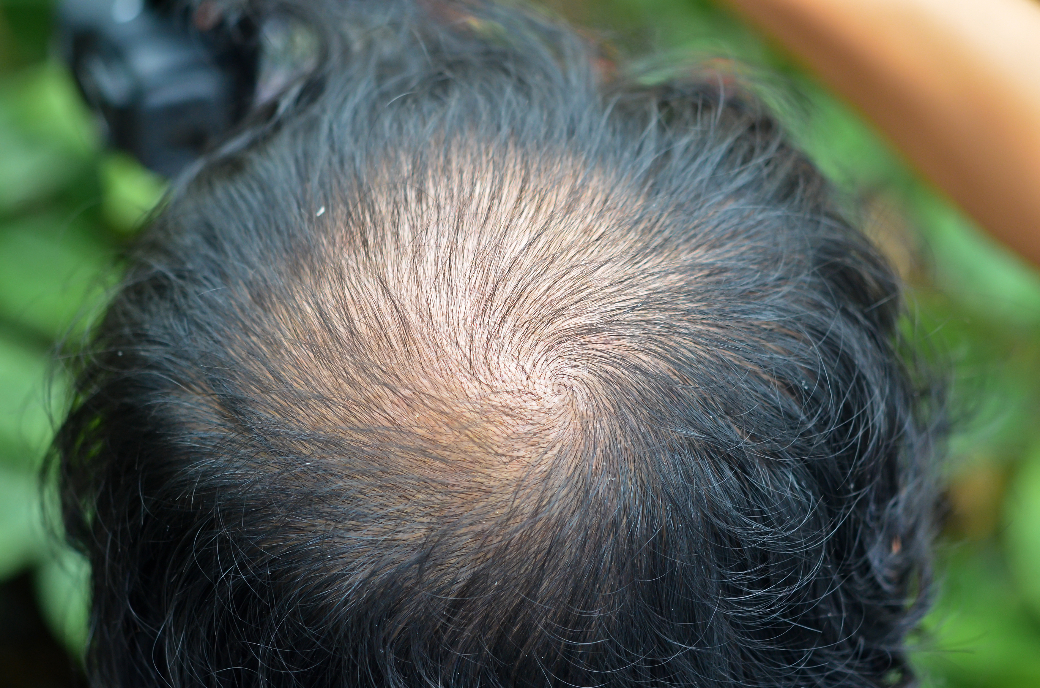 頭頂部の薄毛の原因と効果的な3つの対策 改善方法 Haelier ハエリエ