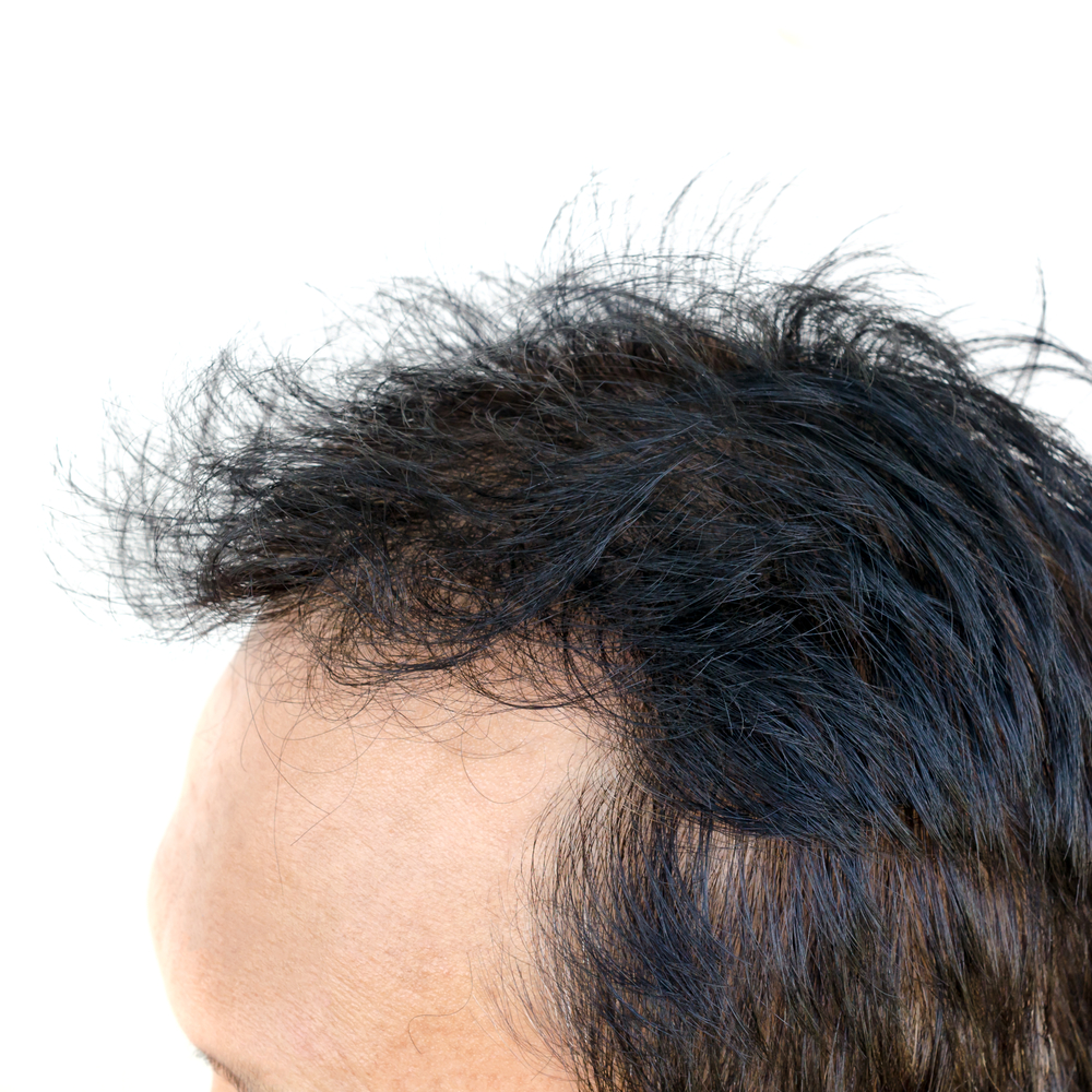 側頭部やこめかみにできるハゲ 薄毛の原因と対策を解説 Haelier ハエリエ