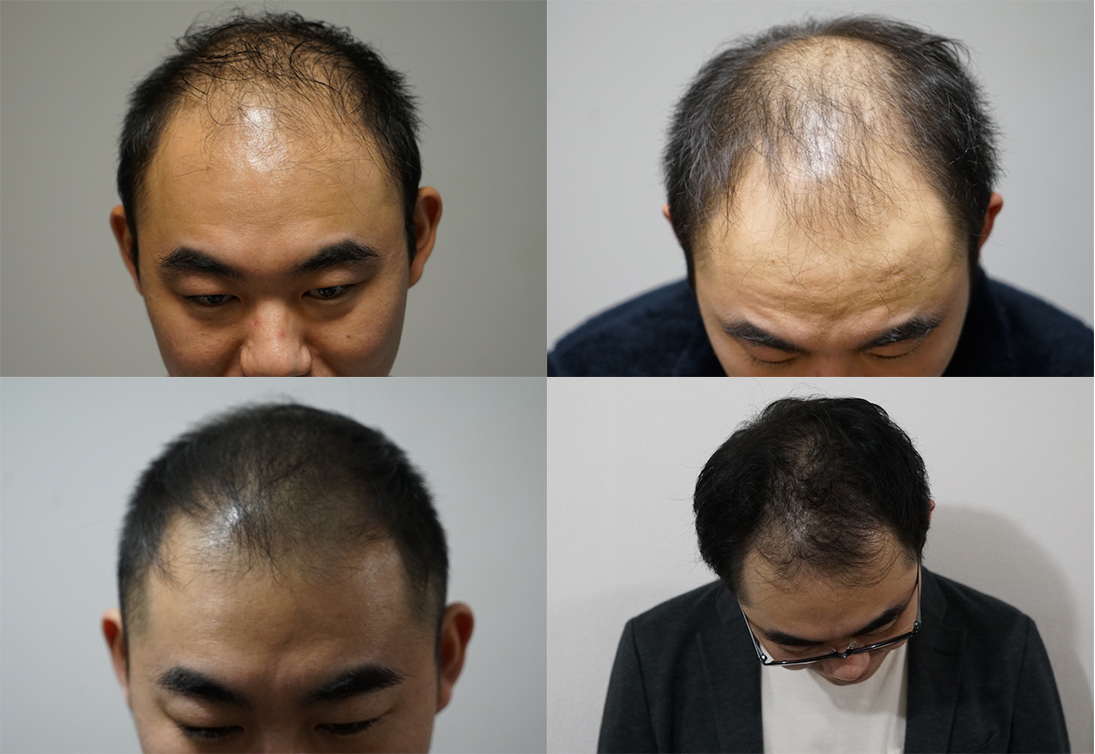 メディカルミノキ5で効果的にaga治療するために知っておきたい最強発毛コンボ Haelier ハエリエ